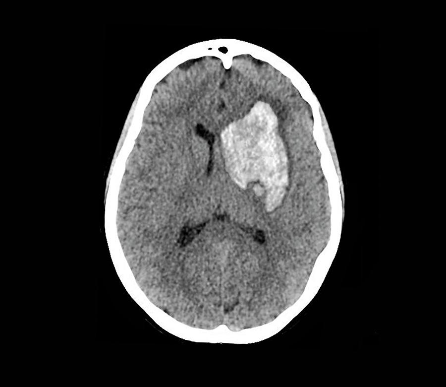 Intracerebral Haemorrhage 1 By Zephyrscience Photo Library 1233