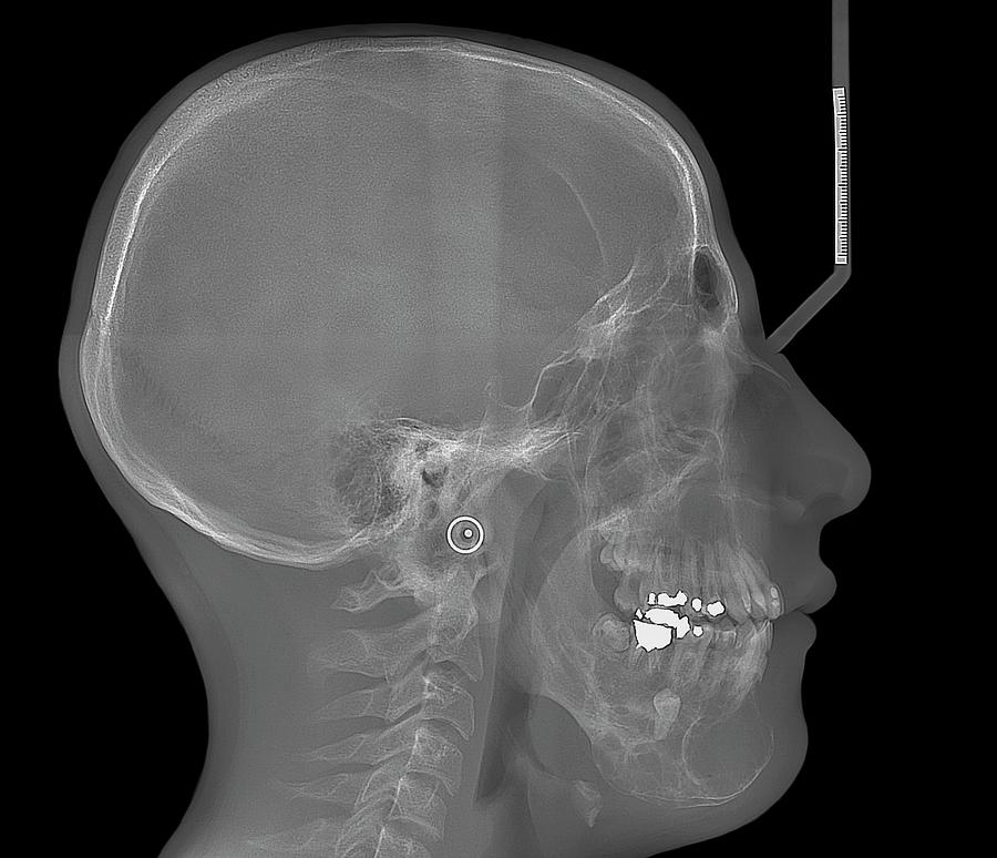 Jaw Cancer (ameloblastoma) #1 Photograph by Zephyr/science Photo Library