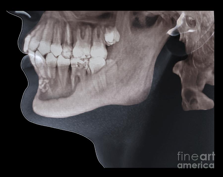 Jaw Tumour, Ct Scan #1 Photograph by Zephyr
