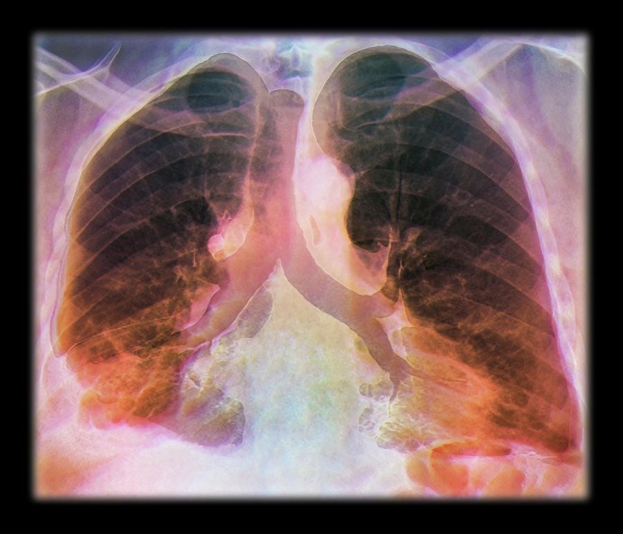 Kaposi's Sarcoma Of The Lung #1 by Zephyr/science Photo Library