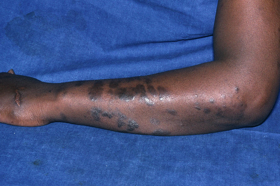 Kaposi's Sarcoma Skin Plaques Photograph By Dr M.a. Ansary/science ...