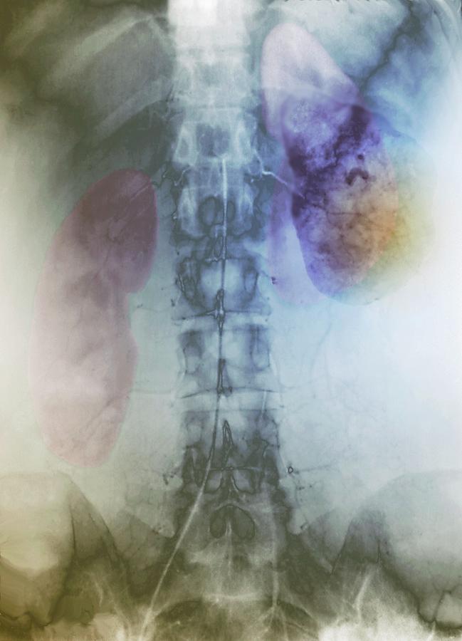 Colour Photograph - Kidney Cancer by Zephyr/science Photo Library Colour Photograph - Kidney Cancer by Zephyr/science Photo Library
