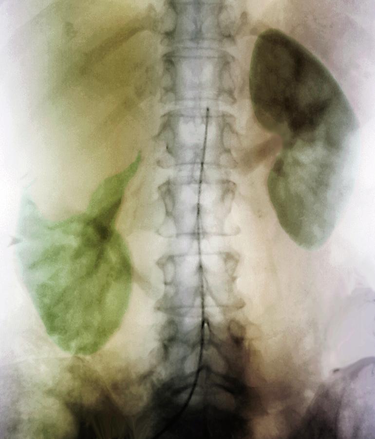 Colour Photograph - Kidney Cyst by Zephyr/science Photo Library Colour Photograph - Kidney Cyst by Zephyr/science Photo Library