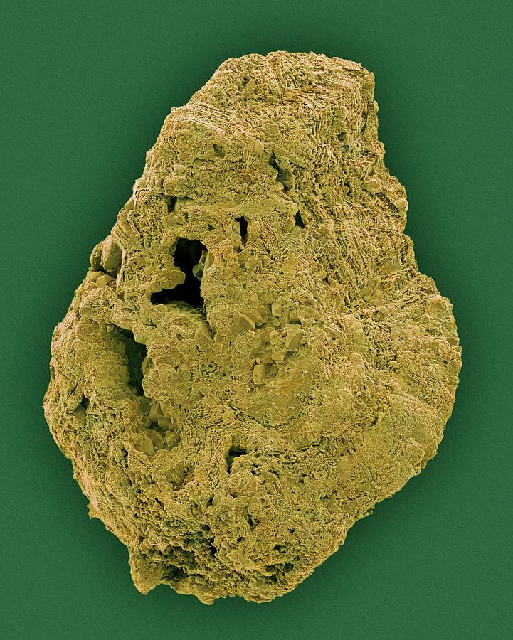 Kidney Stone #1 Photograph by Dennis Kunkel Microscopy/science Photo Library