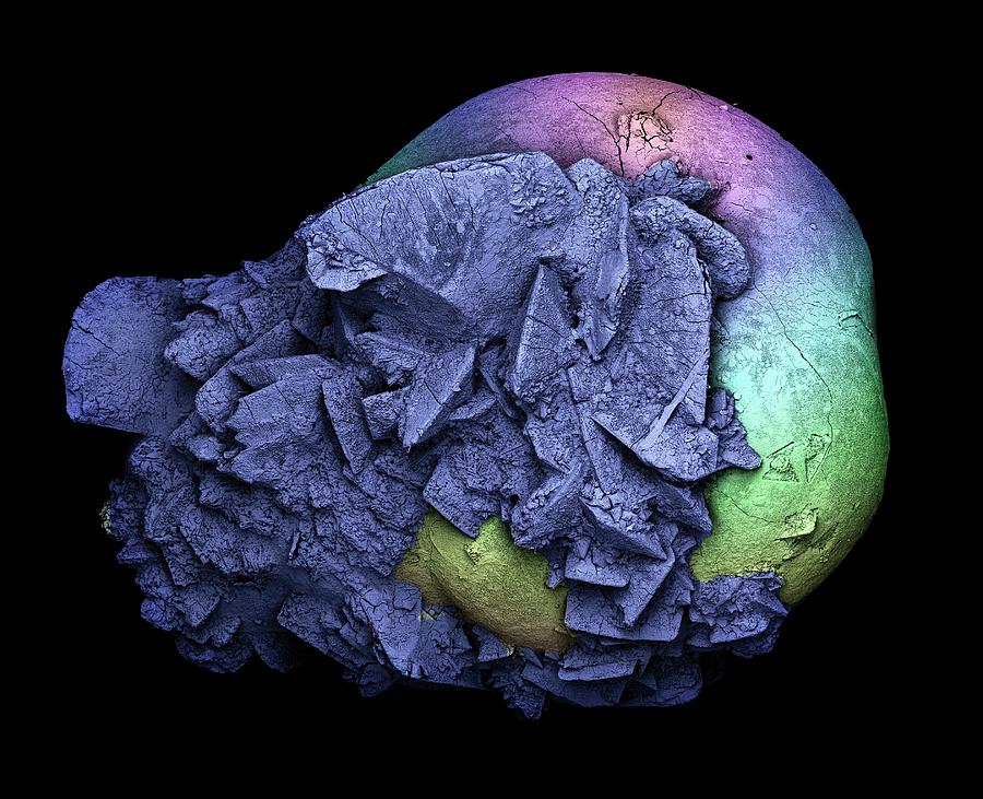 Kidney Stone #1 Photograph by Kevin Mackenzie / University Of Aberdeen / Science Photo Library