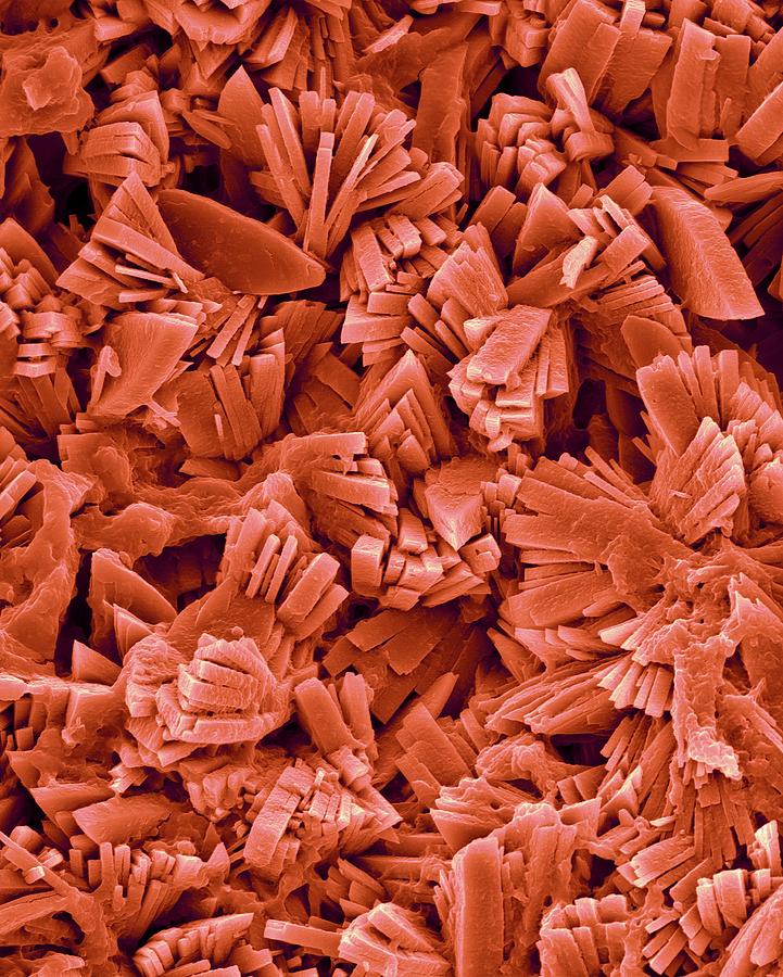 Kidney Stone Monoclinic Crystals #1 Photograph by Dennis Kunkel Microscopy/science Photo Library