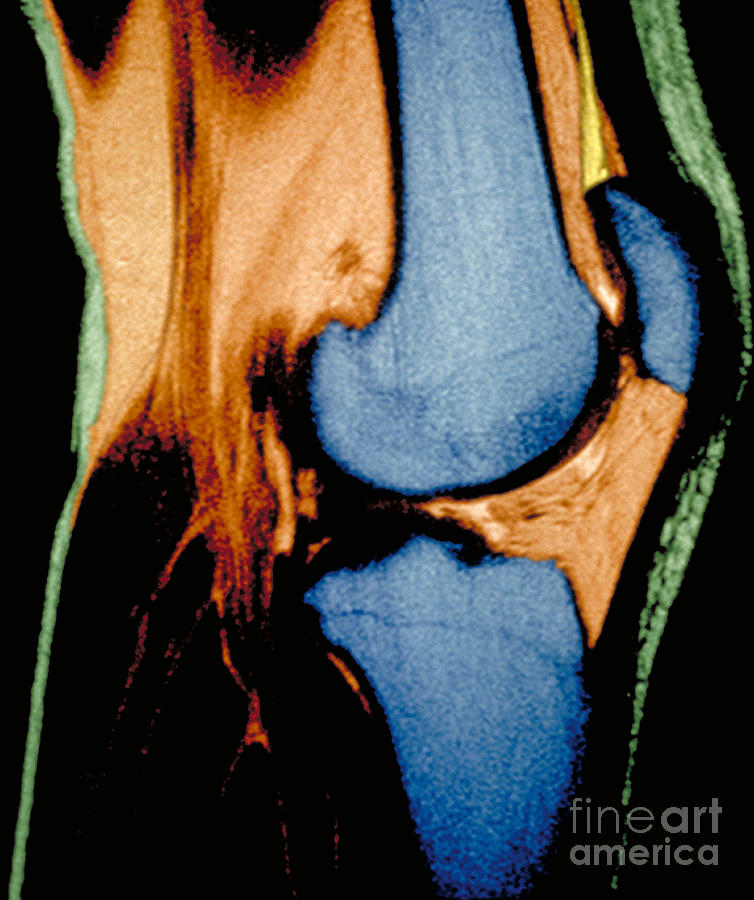Knee Joint #1 Photograph by Susan Leavines