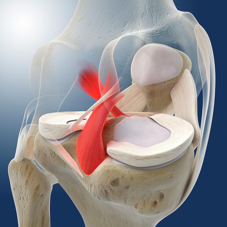 Knee Pain #1 Photograph by Springer Medizin/science Photo Library