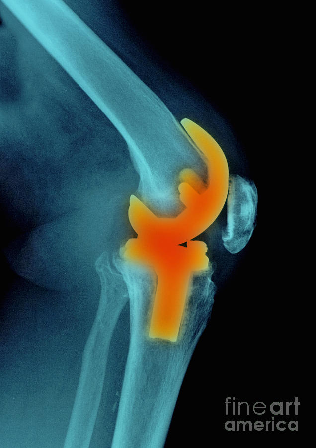 Skeleton Photograph - Knee Replacement, X-ray #1 by Scott Camazine