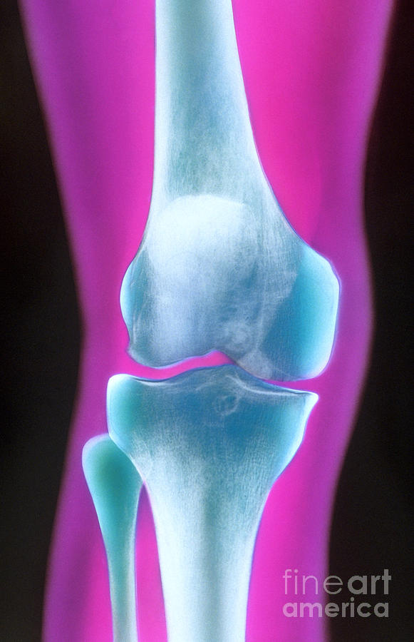 Knee X-ray Of A 72 Year Old Woman #1 Photograph by Chris Bjornberg