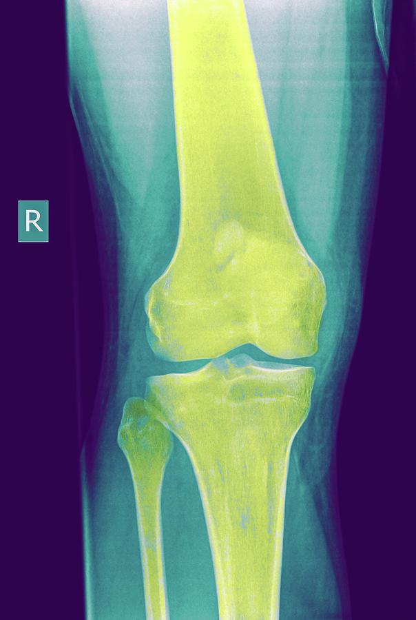 Skeleton Photograph - Knee X-ray #1 by Photostock-israel