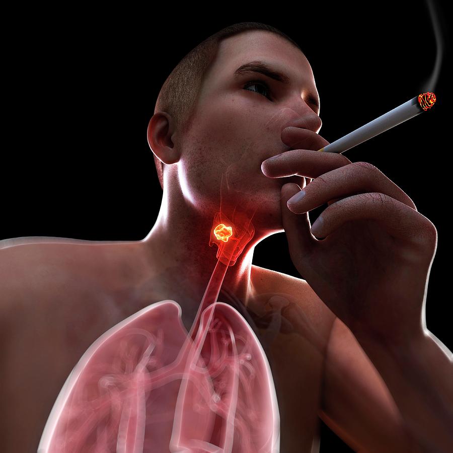 throat cancer from tobacco