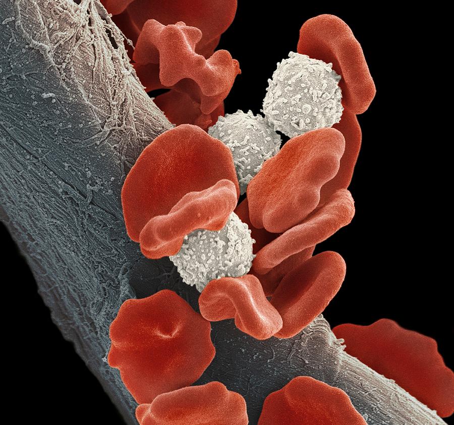 Leukaemia blood cells, SEM #1 Photograph by Science Photo Library - STEVE GSCHMEISSNER.