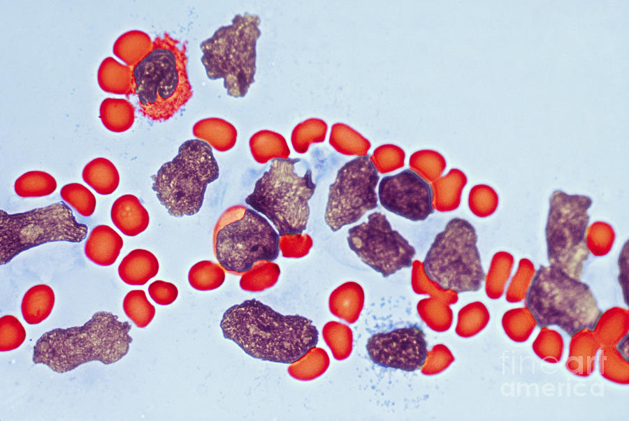 Leukemia #1 Photograph by Biology Pics