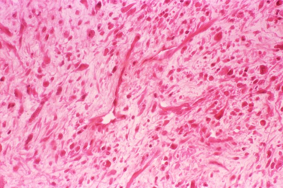 Liposarcoma Photograph By Cnri