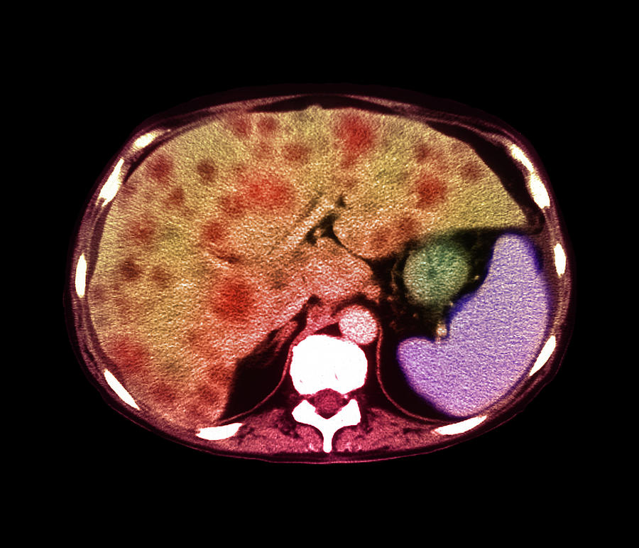 Liver Cancer Ct Scan Photograph By Simon Fraserfreeman Hospital Newcastle Upon Tynescience