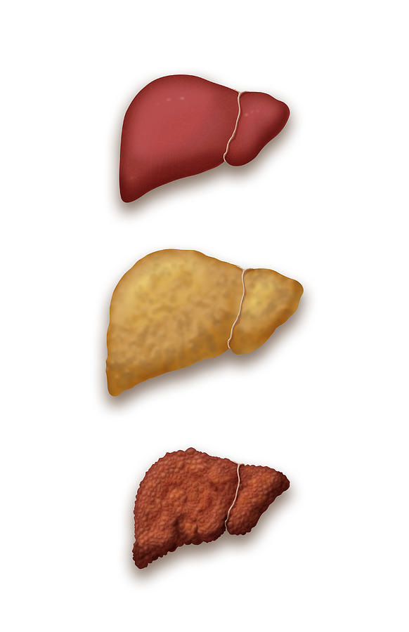 Liver Disease Progression, Illustration #1 Photograph by Monica Schroeder