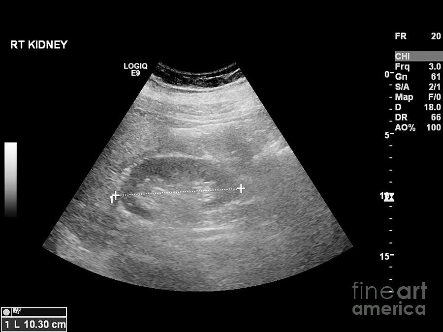 Liver Mass Ultrasound My Xxx Hot Girl