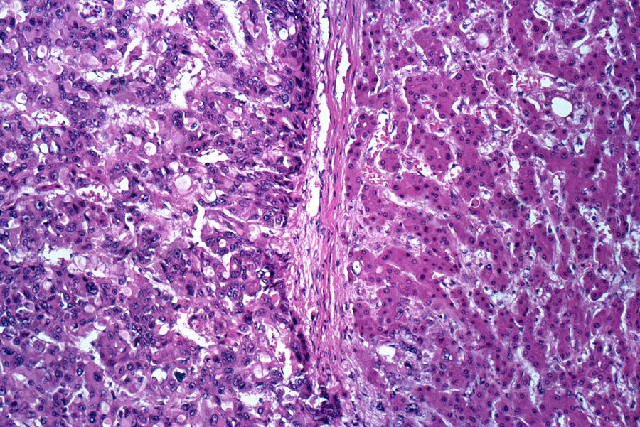 Liver With Carcinoma, Lm #1 Photograph by Michael Abbey