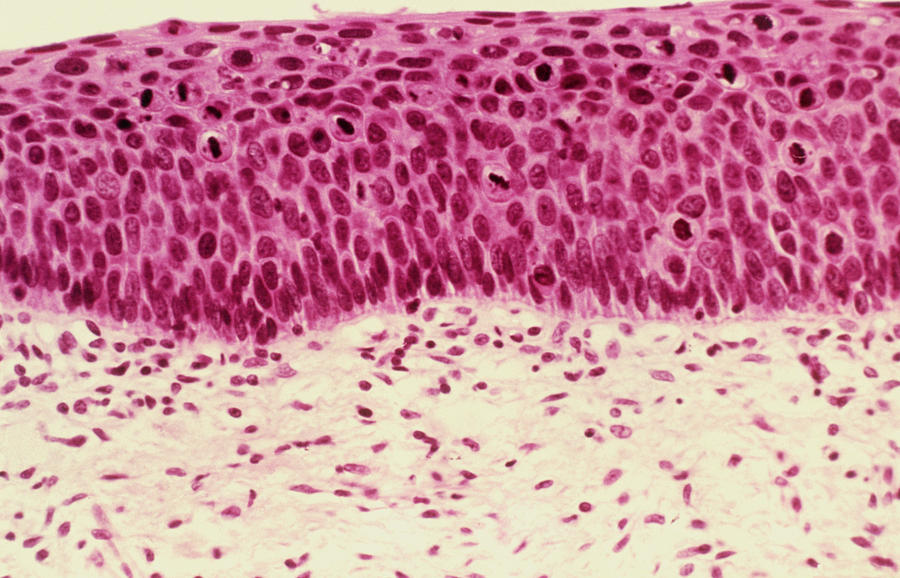 Lm Of Cervical Cells Showing Severe Dysplasia Photograph by Science ...