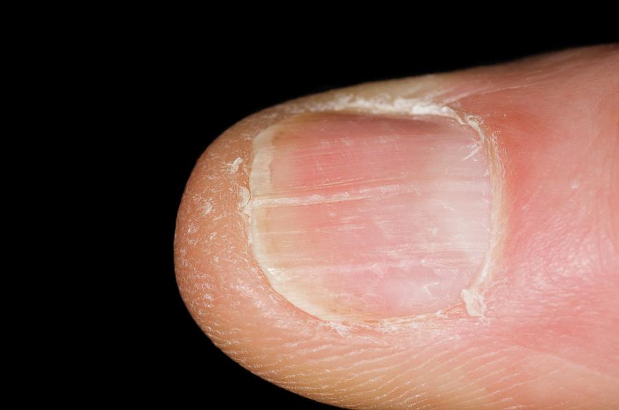 Longitudinal Ridges Along The Fingernail Photograph by Dr P. Marazzi ...