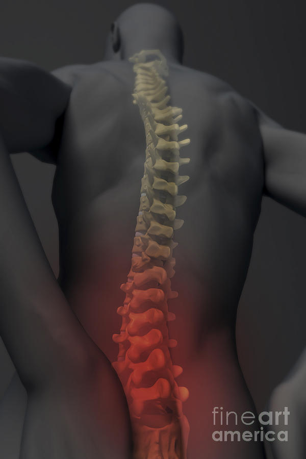 Lower Back Pain #1 Photograph by Science Picture Co