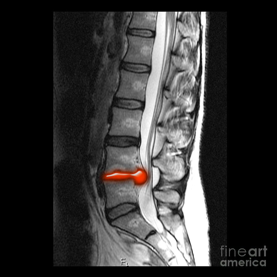 Top 100+ Pictures Mri Pictures Of Herniated Disc Excellent