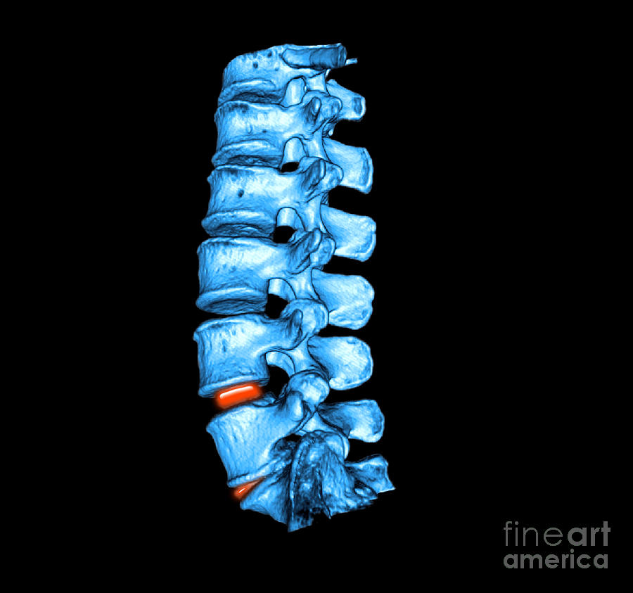 Lumbar Spine #6 Photograph by Living Art Enterprises LLC