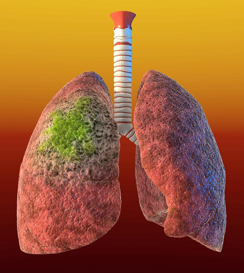 Lung Cancer Photograph by Animated Healthcare Ltd/science Photo Library ...