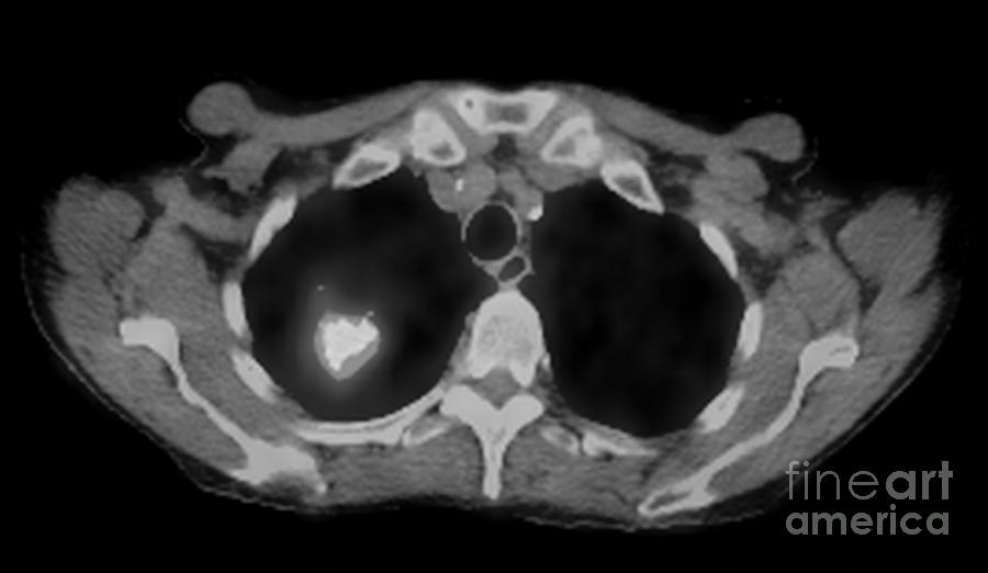 how-a-pet-scan-can-diagnose-lung-cancer