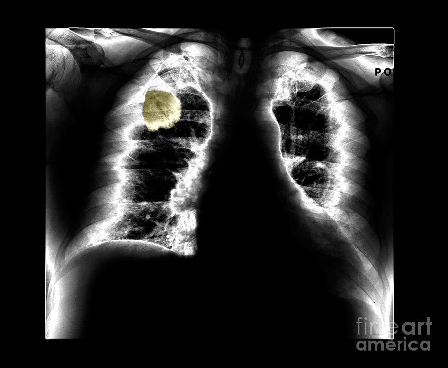 Lung Cancer, X-ray #1 Photograph by Living Art Enterprises