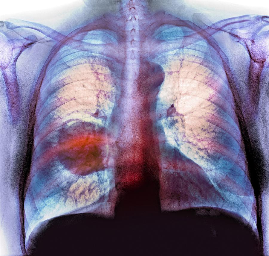 Lung cancer, X-ray Photograph by Science Photo Library - Fine Art America