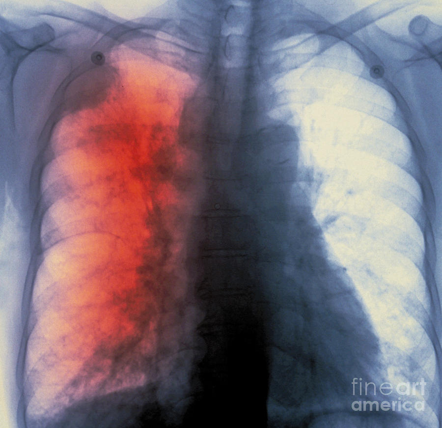 Lung Cancer X-ray #1 Photograph by Scott Camazine