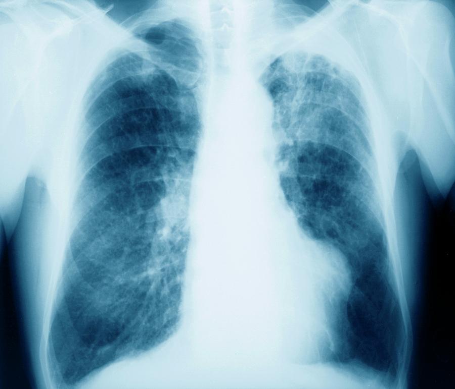 Lung Cancer #1 Photograph by Zephyr/science Photo Library