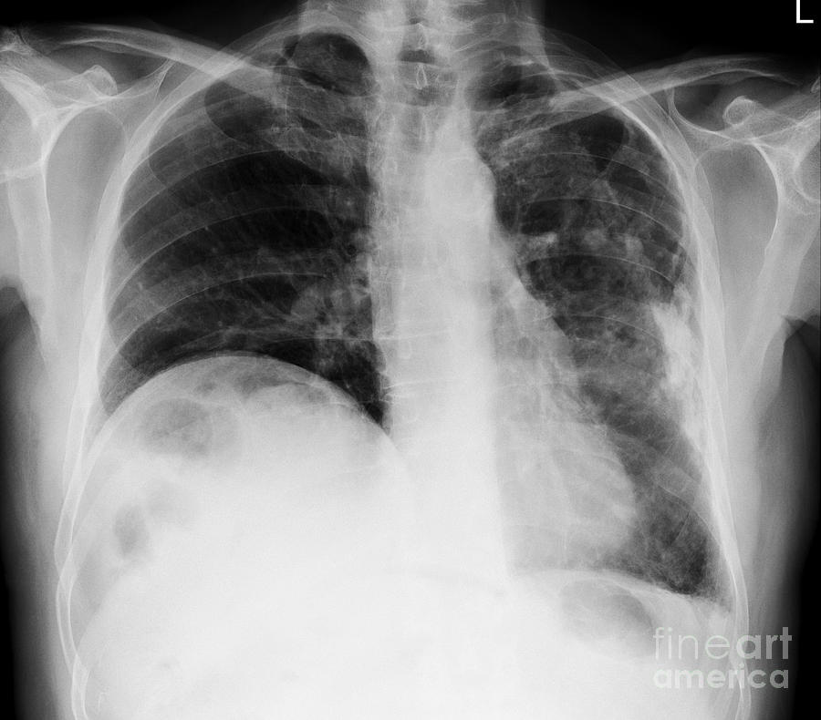 Lung Disease, X-ray #1 Photograph by Science Photo Library - Fine Art ...