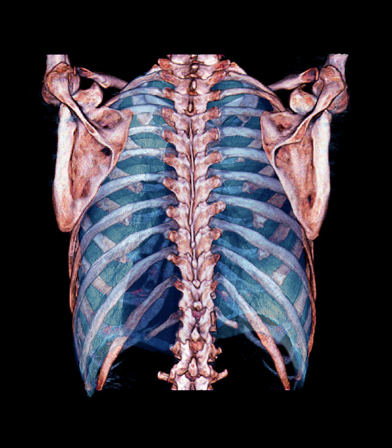 Organ Photograph - Lungs And Thorax Bones #1 by Zephyr/science Photo Library