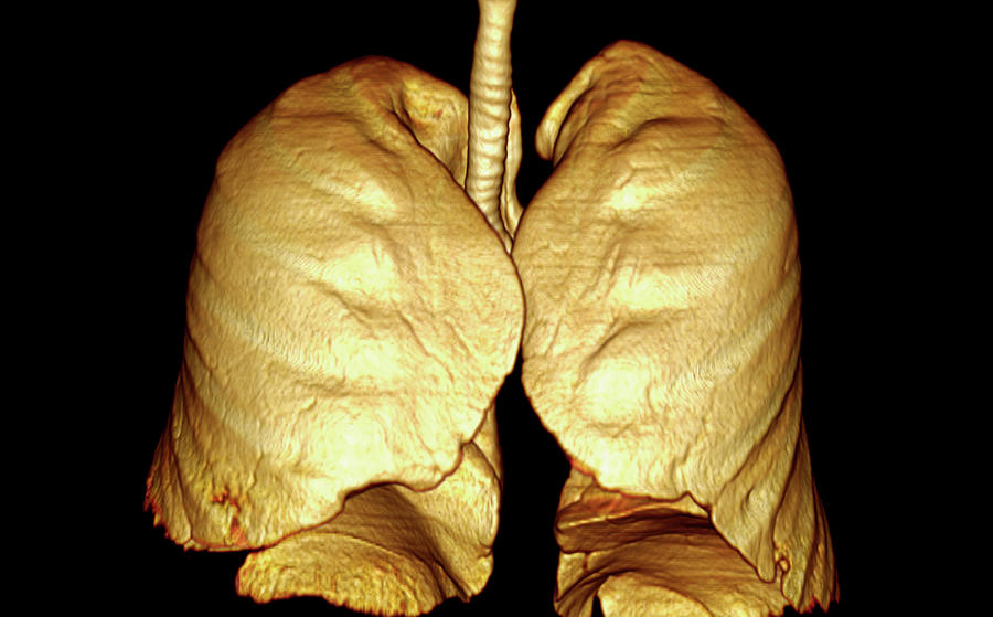 Lungs Photograph by Antoine Rosset/science Photo Library - Fine Art America