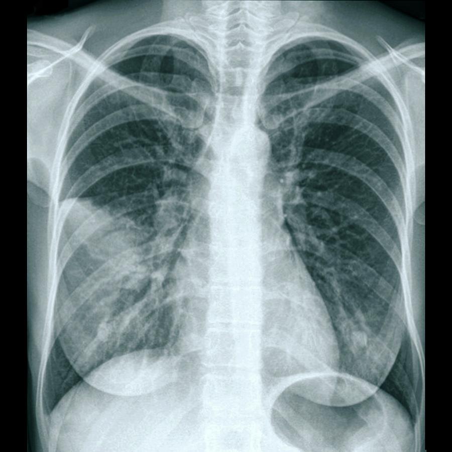 Lungs In Pneumonia Photograph by Zephyr/science Photo Library | Fine ...