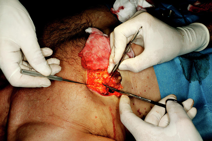 Male Breast Reduction Surgery #1 Photograph by Mauro Fermariello/science Photo Library