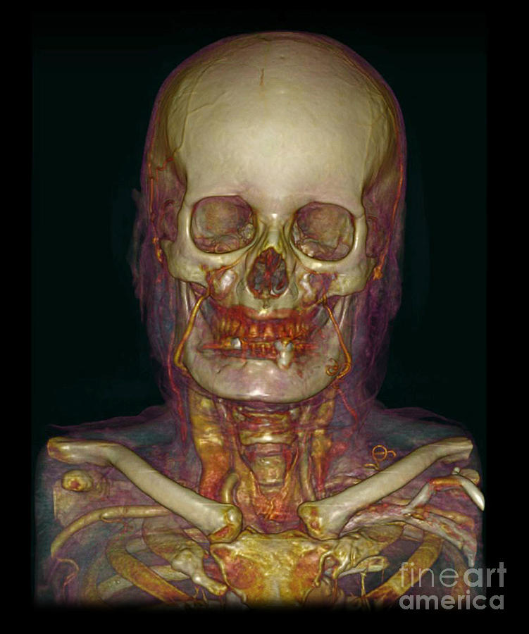 Male Skull & Arterial System #1 Photograph by Scott Camazine
