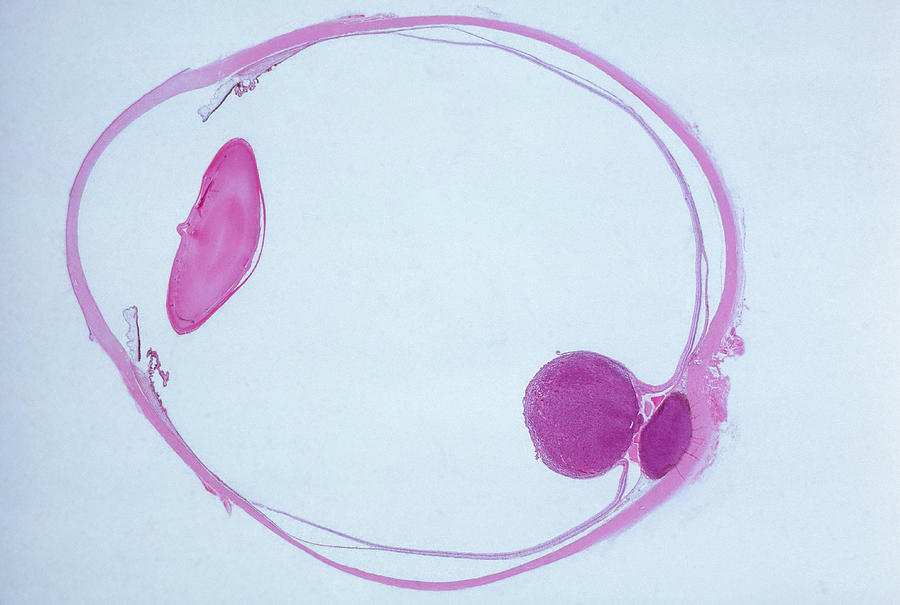 Malignant Melanoma Of Retina, Lm #1 Photograph by Michael Abbey