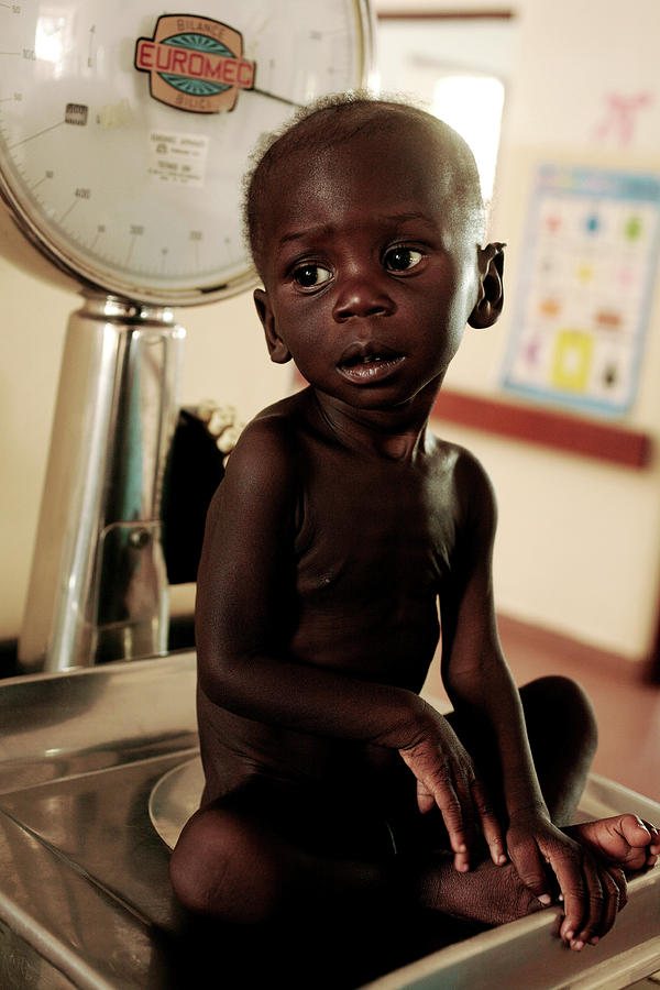 Malnourished Child Being Weighed Photograph by Mauro Fermariello ...