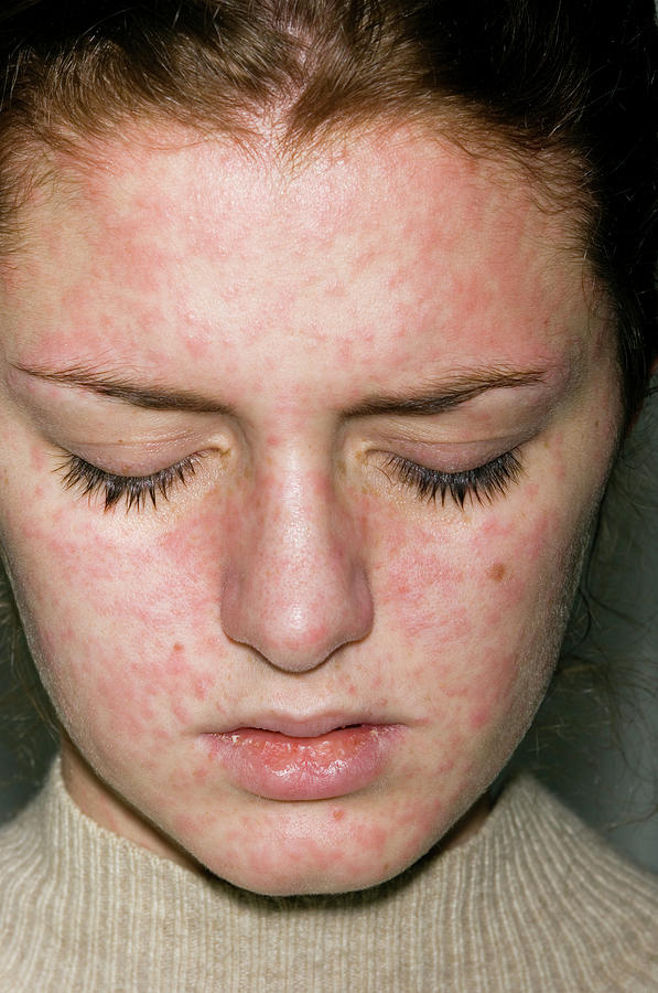 Measles Rash Photograph By Dr P Marazziscience Photo Library