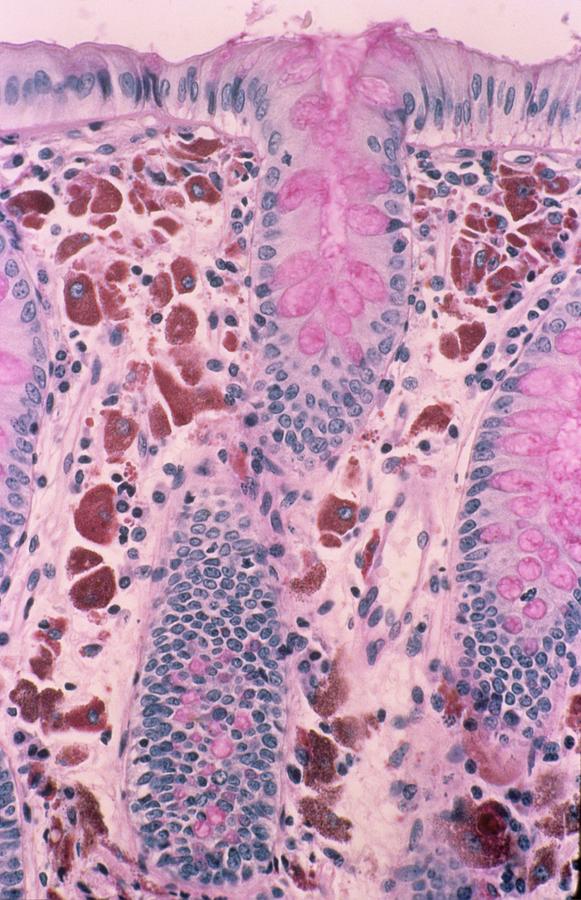 Melanosis Coli #1 Photograph by Cnri