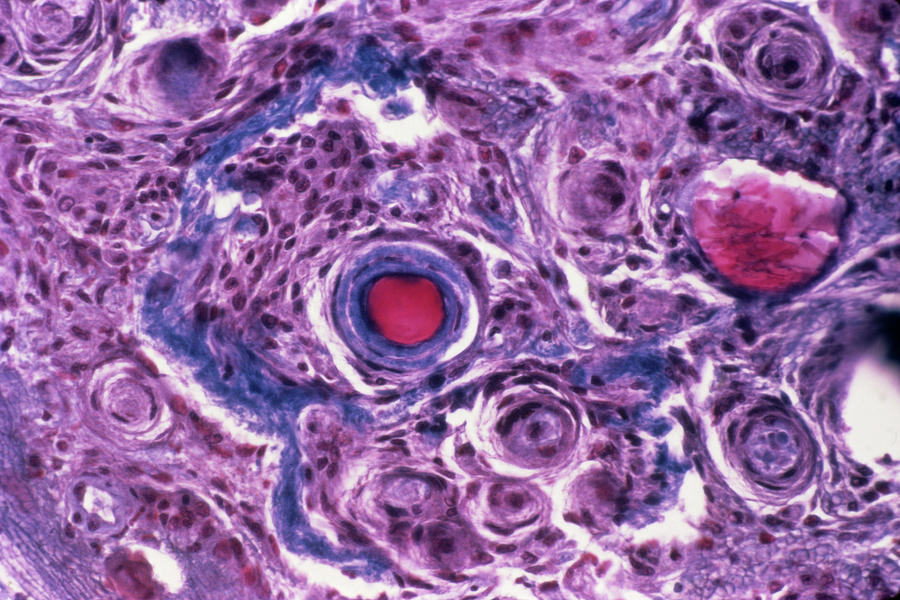 Meningioma Brain Tumour #1 Photograph by Cnri/science Photo Library