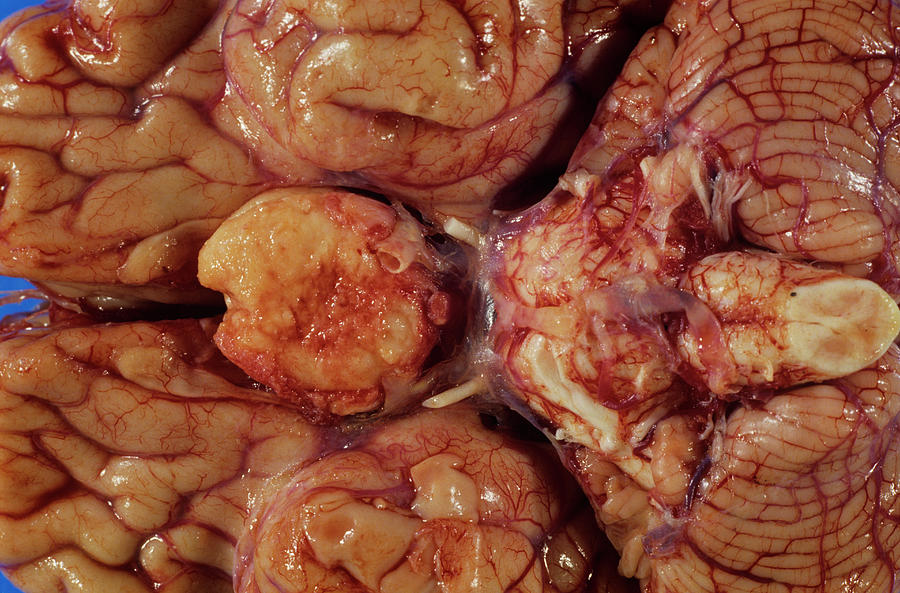 Meningioma Brain Tumour #1 Photograph by Dr. E. Walker/science Photo Library
