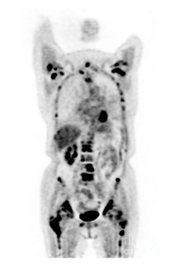 Metastatic Disease Pet Scan #1 Photograph by Living Art Enterprises