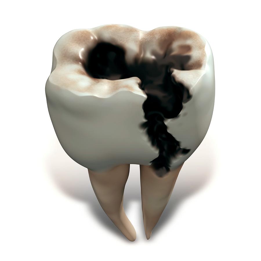 Molar Tooth Decay #1 Photograph by Science Artwork/science Photo Library