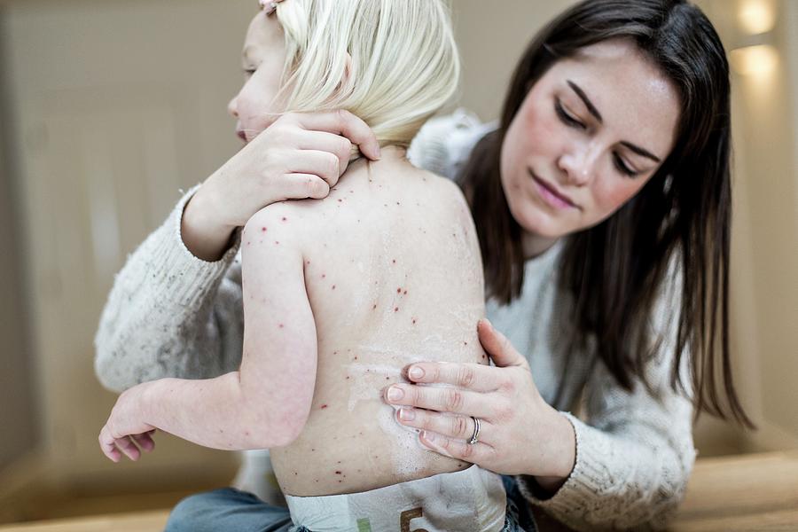 Mother Treating Daughter With Chickenpox #1 Photograph by Samuel Ashfield/science Photo Library