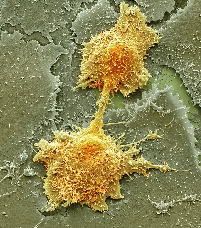 Abnormal Photograph - Mouth cancer cell dividing, SEM #1 by Science Photo Library